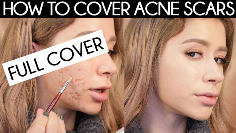 How To Cover Acne Scars The Right Way